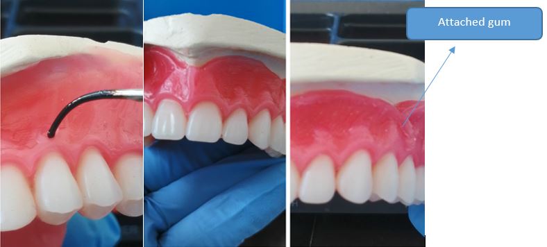 attached gum characterization kit opti-cryl veracril